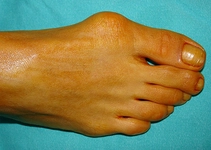 Kemik Büyümesi Hastalığı Belirtileri ve Tedavisi