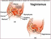 Vajinismus Hastalığı Belirtileri ve Tedavisi