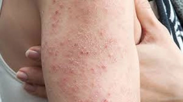 Yılancık Hastalığı Belirtileri ve Tedavisi