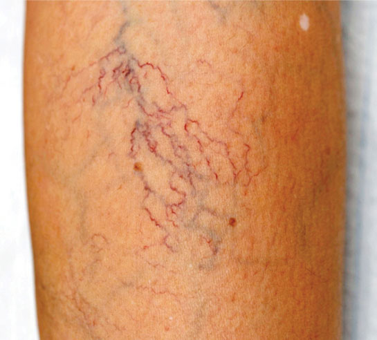 Kılcal Damar Hastalıkları Belirtileri ve Tedavisi