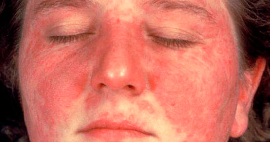 Lupus Hastal