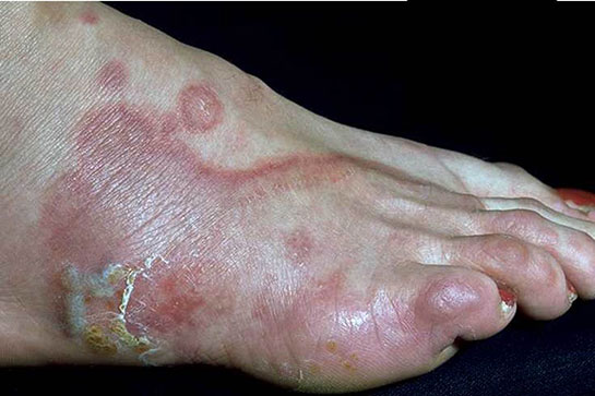 Mantar Hastalığı Belirtileri ve Tedavisi