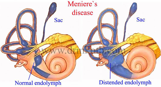 Meniere Hastalığı Belirtileri ve Tedavisi
