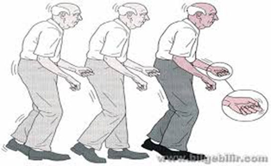 Parkinson Hastal Nedir