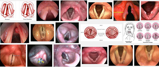 Ses Teli Hastalıkları Belirtileri ve Tedavisi