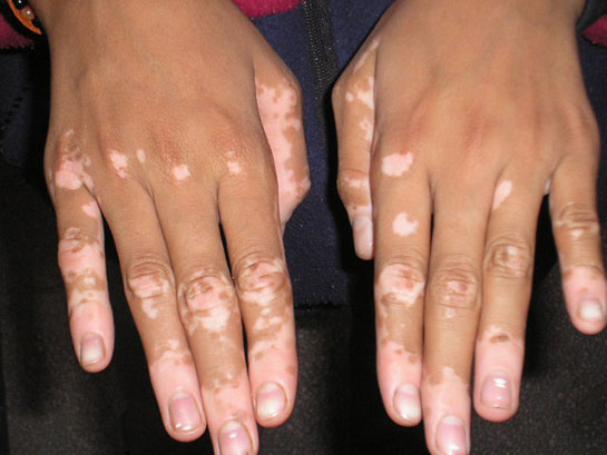 Vitiligo Hastal
